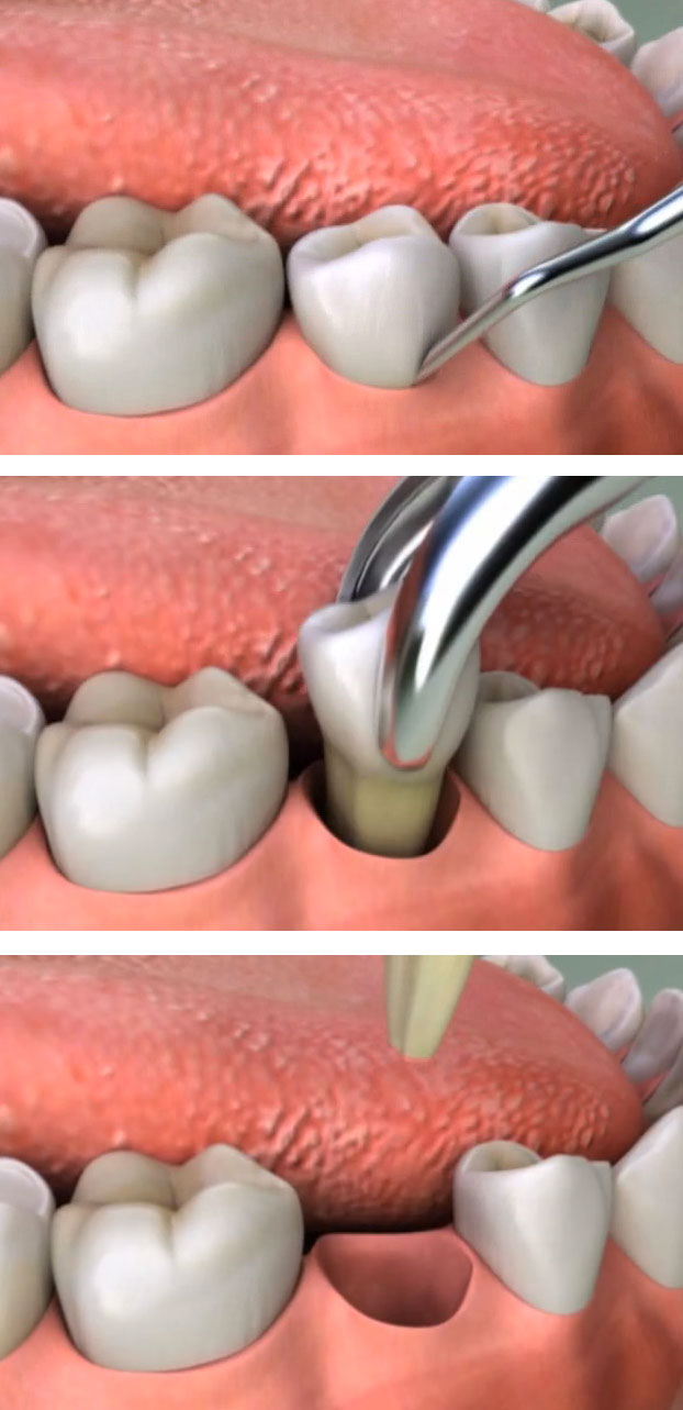 Tooth Extractions – Total Care Dental & Orthodontics