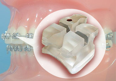 Orthodontic Bracket
